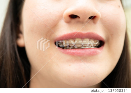 Asian woman wearing Hawley retainer removable orthodontic appliance maintain position of teeth. Asian woman wearing Hawley retainer removable orthodontic appliance maintain position of teeth. 137958354