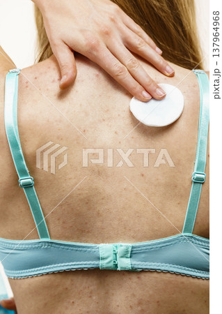 Woman acne on back cleaning skin with tonic Woman acne on back cleaning skin with tonic 137964968
