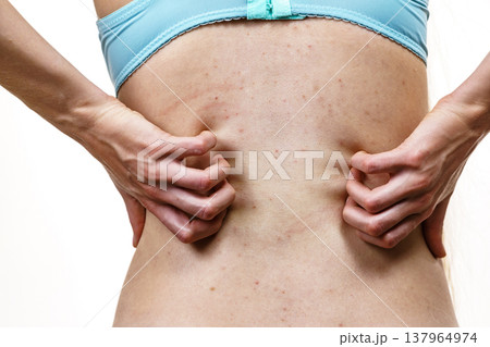 Woman scratching her itchy back with allergy rash 137964974