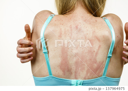 Woman scratching her itchy back with allergy rash Woman scratching her itchy back with allergy rash 137964975