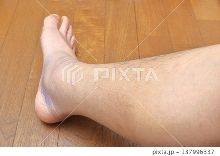 右足ふくらはぎの肉離れ (四日目) 137996337