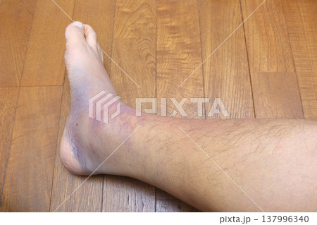 右足ふくらはぎの肉離れの影響 (六日目) 137996340
