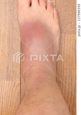 右足ふくらはぎの肉離れの影響(八日目) 137996349