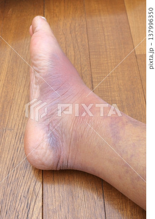 右足ふくらはぎの肉離れの影響 (八日目) 137996350