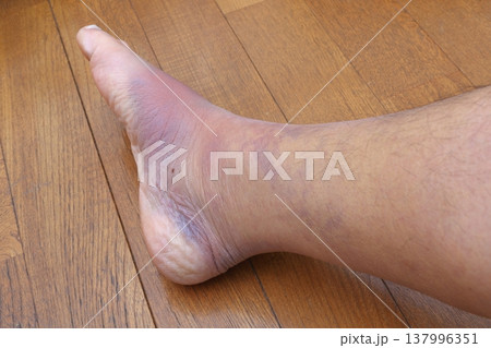 右足ふくらはぎの肉離れの影響 (八日目) 137996351