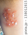 Woman with shingles on the skin she feels very painful 138012815