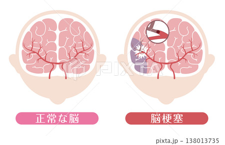 脳梗塞と正常な脳の比較 医療イラスト 脳梗塞と正常な脳の比較 医療イラスト 138013735