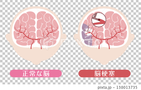 脳梗塞と正常な脳の比較 医療イラスト 脳梗塞と正常な脳の比較 医療イラスト 138013735