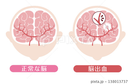脳出血と正常な脳の比較 医療イラスト 138013737
