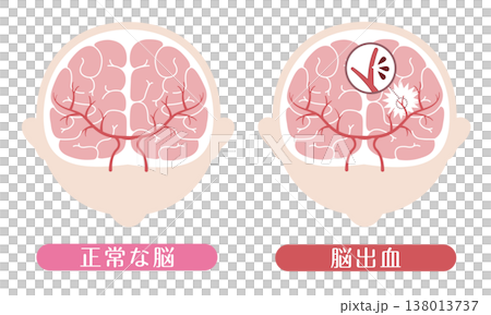脳出血と正常な脳の比較 医療イラスト 138013737