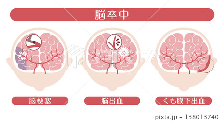 脳卒中の種類（脳梗塞・脳出血・くも膜下出血）医療イラスト 138013740