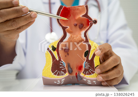 Asian doctor with rectum and hemorrhoid human model, inflamed vascular structure. Asian doctor with rectum and hemorrhoid human model, inflamed vascular structure. 138026245