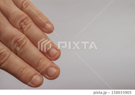 Close-up of four female fingers on a white background with badly bitten nails and dry cuticles. Raw image of unkempt hands needing care, with large copy space on the right Close-up of four female fingers on a white background with badly bitten nails and dry cuticles. Raw image of unkempt hands needing care, with large copy space on the right 138033905