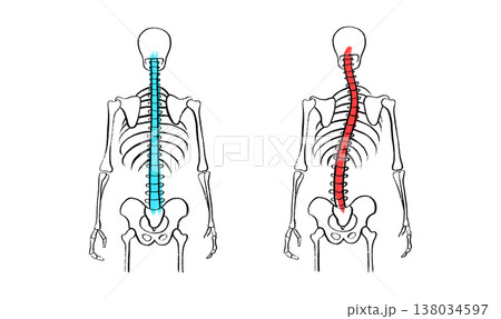 Scoliosis spine deformity Scoliosis spine deformity 138034597