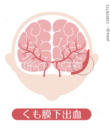 くも膜下出血 医療イラスト くも膜下出血 医療イラスト 138076772