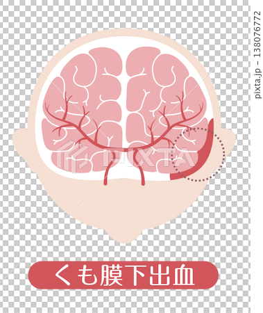 くも膜下出血 医療イラスト くも膜下出血 医療イラスト 138076772