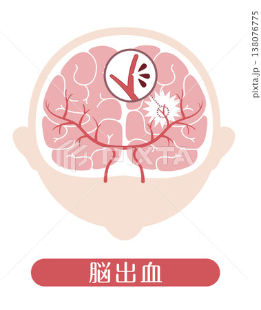 脳出血 医療イラスト 脳出血 医療イラスト 138076775