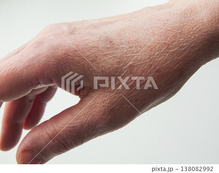 Senior woman hand aging symptoms, dry thin skin on back of hand, dehydration and vitamin deficiency. 138082992