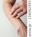 Senior woman touching showing dry skin on arm, dehydration and seasonal disease, aging symptoms. 138082993
