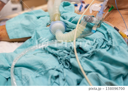 Close up of ventilator tubing and connectors on patient in hospital highlighting critical care respiratory support medical treatment monitoring and clinical environment with soft fabric Close up of ventilator tubing and connectors on patient in hospital highlighting critical care respiratory support medical treatment monitoring and clinical environment with soft fabric 138096700