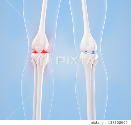 Inflamed and healthy knee joint anatomy 3D model. Leg bones with red glow pain on medical blue background. Rheumatoid arthritis or sports injury for orthopedic diagnosis and treatment. 3D illustration Inflamed and healthy knee joint anatomy 3D model. Leg bones with red glow pain on medical blue background. Rheumatoid arthritis or sports injury for orthopedic diagnosis and treatment. 3D illustration 138108665