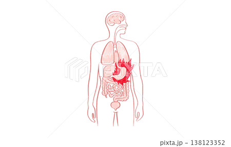 Gastroesophageal reflux pain Gastroesophageal reflux pain 138123352