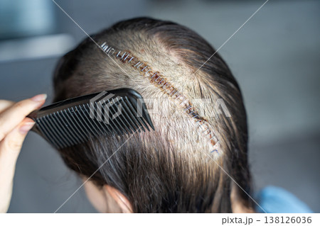Woman carefully combing hair near surgical scar with staples after craniotomy for brain tumor removal. Postoperative care and recovery routine concept. Woman carefully combing hair near surgical scar with staples after craniotomy for brain tumor removal. Postoperative care and recovery routine concept. 138126036