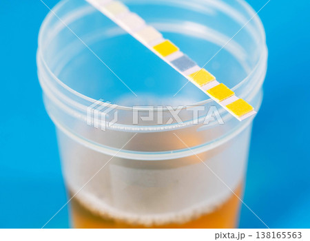 A test strip on a container with urine reflecting the degree of acidity of urine and the degree of inflammation in the urinary tract, close-up. A test strip on a container with urine reflecting the degree of acidity of urine and the degree of inflammation in the urinary tract, close-up. 138165563