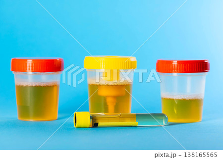 A urine test tube against the background of urine containers for testing for alpha amylase and microalbuminuria, a highly accurate test for early diagnosis of diseases. Copy space for text 138165565