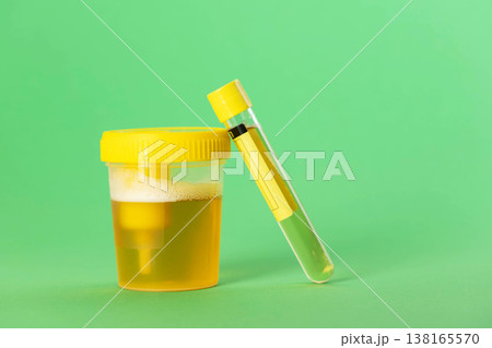 A test tube with reagent and urine on a green background. Bacterial culture for Enterobacteriaceae and Staphylococcus saprophyticus bacteria, which cause pain and inflammation in the urinary tract. 138165570