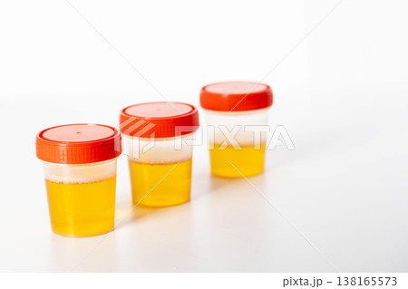 A three-glass urine sample on a white background. Urine analysis for leukocytes, turbidity, and mucus in kidney stones, close-up A three-glass urine sample on a white background. Urine analysis for leukocytes, turbidity, and mucus in kidney stones, close-up 138165573