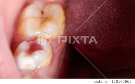 Close-up view of molar tooth with chipped red filling showing exposed tooth structure and signs of decay, adjacent to another discolored tooth Close-up view of molar tooth with chipped red filling showing exposed tooth structure and signs of decay, adjacent to another discolored tooth 138165663