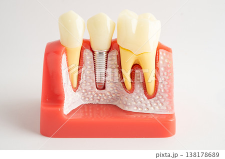 Dental implant, artificial tooth roots into jaw isolated on white background with clipping path. Dental implant, artificial tooth roots into jaw isolated on white background with clipping path. 138178689