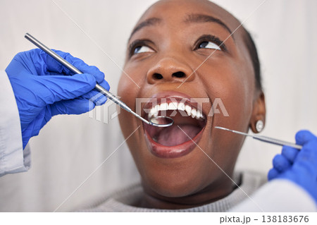Dentist hands, patient mouth and tools, check teeth for dental health and medical treatment. Oral hygiene, healthcare and orthodontics, black woman with tooth decay and clean for cavity and excavator Dentist hands, patient mouth and tools, check teeth for dental health and medical treatment. Oral hygiene, healthcare and orthodontics, black woman with tooth decay and clean for cavity and excavator 138183676