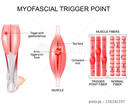 Myofascial trigger point in leg. Muscle fibers with contracture knots and taut band 138192197