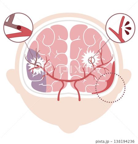 脳卒中の種類比較イラスト（脳梗塞・脳出血・くも膜下出血） 138194236