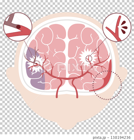 脳卒中の種類比較イラスト（脳梗塞・脳出血・くも膜下出血） 138194236