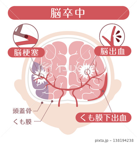 脳卒中の種類比較イラスト(脳梗塞・脳出血・くも膜下出血) 脳卒中の種類比較イラスト(脳梗塞・脳出血・くも膜下出血) 138194238