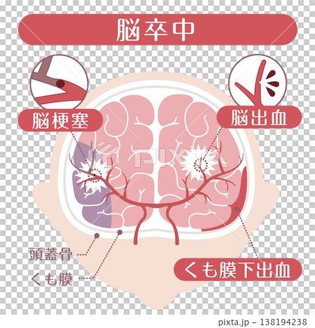 脳卒中の種類比較イラスト(脳梗塞・脳出血・くも膜下出血) 脳卒中の種類比較イラスト(脳梗塞・脳出血・くも膜下出血) 138194238