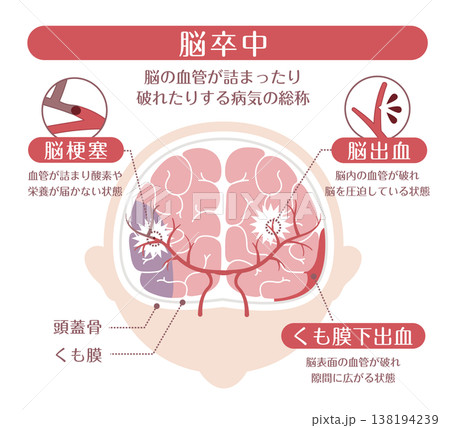 脳卒中の種類比較イラスト（脳梗塞・脳出血・くも膜下出血） 138194239