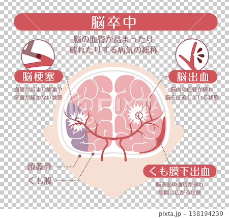 脳卒中の種類比較イラスト（脳梗塞・脳出血・くも膜下出血） 138194239