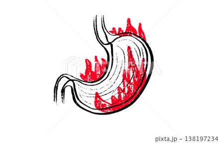 Gastroesophageal reflux pain Gastroesophageal reflux pain 138197234