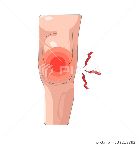 Illustration of knee pain Illustration of knee pain 138215892