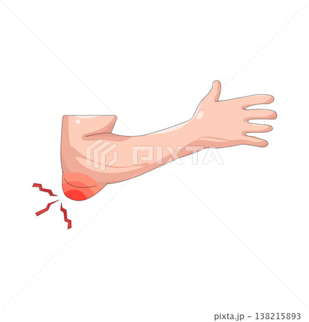 Illustration of elbow pain Illustration of elbow pain 138215893