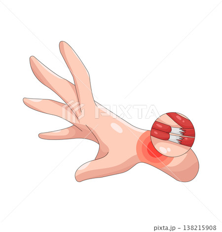 Illustration of wrist pain Illustration of wrist pain 138215908