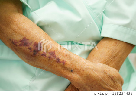 Ecchymosis, elderly bleeding on her arm after taking aspirin. 138234433