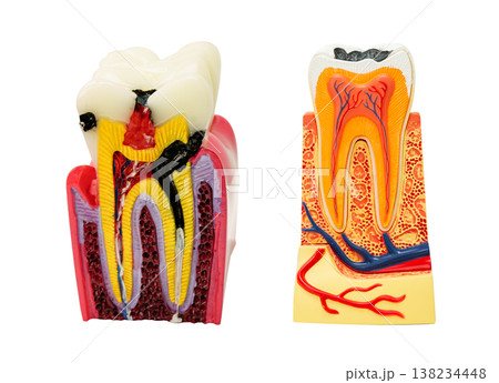 Dental implant, artificial tooth roots into jaw human model isolated on white background. Dental implant, artificial tooth roots into jaw human model isolated on white background. 138234448