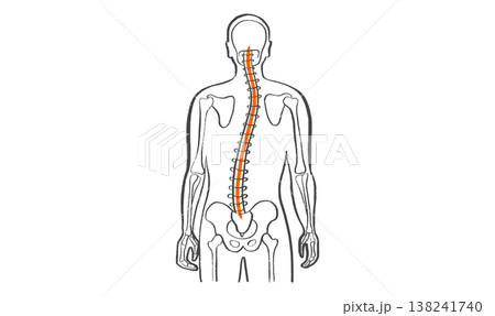 Scoliosis spine deformity Scoliosis spine deformity 138241740