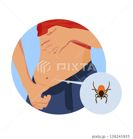 Removing encephalitis ticks after bite. How to remove mite. Parasite carrying disease.Woman opening underwear to find ticks. 138241935