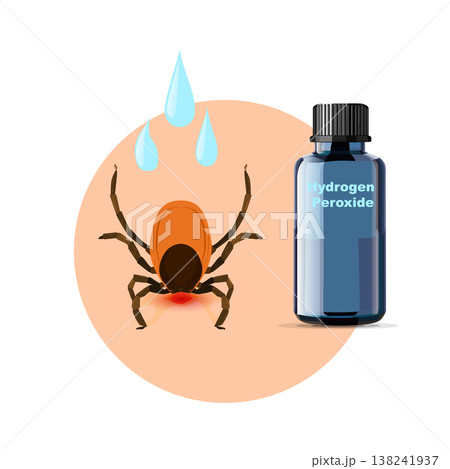 Removing encephalitis ticks after bite. How to remove mite. Parasite carrying disease.Disinfect with hydrogen peroxide. 138241937